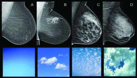 Mammogram